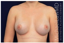 Breast Augmentation After Photo by Michael Law, MD; Raleigh, NC - Case 33108