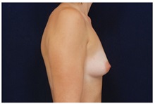 Breast Augmentation Before Photo by Michael Law, MD; Raleigh, NC - Case 33108