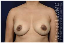 Breast Augmentation After Photo by Michael Law, MD; Raleigh, NC - Case 33110