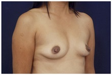 Breast Augmentation Before Photo by Michael Law, MD; Raleigh, NC - Case 33110