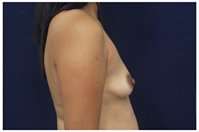 Breast Augmentation Before Photo by Michael Law, MD; Raleigh, NC - Case 33110