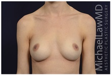 Breast Augmentation After Photo by Michael Law, MD; Raleigh, NC - Case 33113