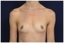 Breast Augmentation Before Photo by Michael Law, MD; Raleigh, NC - Case 33113