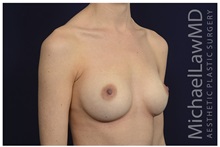 Breast Augmentation After Photo by Michael Law, MD; Raleigh, NC - Case 33113