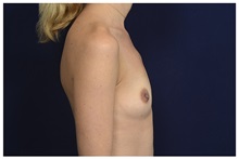 Breast Augmentation Before Photo by Michael Law, MD; Raleigh, NC - Case 33113