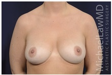 Breast Augmentation After Photo by Michael Law, MD; Raleigh, NC - Case 33114