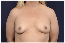 Breast Augmentation Before Photo by Michael Law, MD; Raleigh, NC - Case 33114