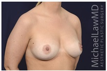 Breast Augmentation After Photo by Michael Law, MD; Raleigh, NC - Case 33114