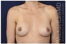 Breast Augmentation After Photo by Michael Law, MD; Raleigh, NC - Case 33116