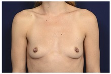 Breast Augmentation Before Photo by Michael Law, MD; Raleigh, NC - Case 33116