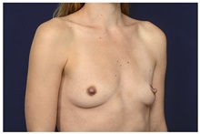 Breast Augmentation Before Photo by Michael Law, MD; Raleigh, NC - Case 33116