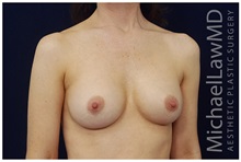 Breast Augmentation After Photo by Michael Law, MD; Raleigh, NC - Case 33117
