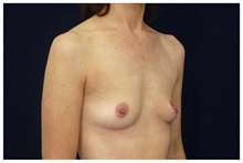 Breast Augmentation Before Photo by Michael Law, MD; Raleigh, NC - Case 33117