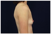 Breast Augmentation Before Photo by Michael Law, MD; Raleigh, NC - Case 33117