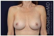 Breast Augmentation After Photo by Michael Law, MD; Raleigh, NC - Case 33119