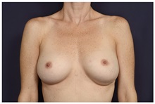 Breast Augmentation Before Photo by Michael Law, MD; Raleigh, NC - Case 33119