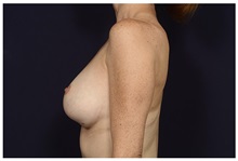 Breast Augmentation Before Photo by Michael Law, MD; Raleigh, NC - Case 33119