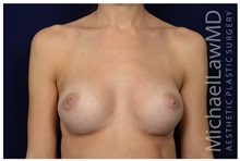 Breast Augmentation After Photo by Michael Law, MD; Raleigh, NC - Case 33121