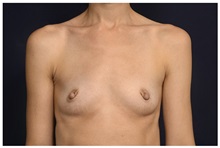 Breast Augmentation Before Photo by Michael Law, MD; Raleigh, NC - Case 33121