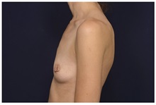 Breast Augmentation Before Photo by Michael Law, MD; Raleigh, NC - Case 33121