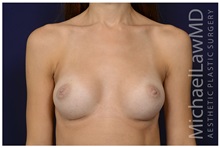Breast Augmentation After Photo by Michael Law, MD; Raleigh, NC - Case 33122