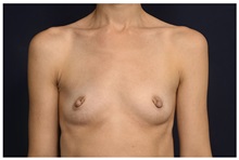 Breast Augmentation Before Photo by Michael Law, MD; Raleigh, NC - Case 33122