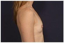 Breast Augmentation Before Photo by Michael Law, MD; Raleigh, NC - Case 33123