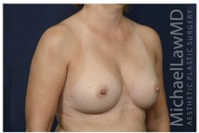 Breast Augmentation After Photo by Michael Law, MD; Raleigh, NC - Case 33123