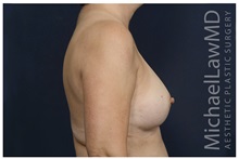 Breast Augmentation After Photo by Michael Law, MD; Raleigh, NC - Case 33123