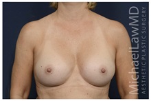 Breast Augmentation After Photo by Michael Law, MD; Raleigh, NC - Case 33125