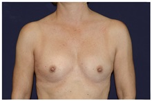 Breast Augmentation Before Photo by Michael Law, MD; Raleigh, NC - Case 33125