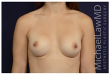 Breast Augmentation After Photo by Michael Law, MD; Raleigh, NC - Case 33126