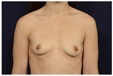 Breast Augmentation Before Photo by Michael Law, MD; Raleigh, NC - Case 33126