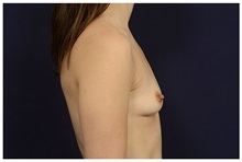 Breast Augmentation Before Photo by Michael Law, MD; Raleigh, NC - Case 33126