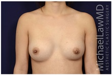 Breast Augmentation After Photo by Michael Law, MD; Raleigh, NC - Case 33129