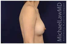 Breast Augmentation After Photo by Michael Law, MD; Raleigh, NC - Case 33129