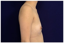 Breast Augmentation Before Photo by Michael Law, MD; Raleigh, NC - Case 33129