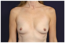 Breast Augmentation Before Photo by Michael Law, MD; Raleigh, NC - Case 33130