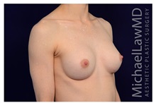 Breast Augmentation After Photo by Michael Law, MD; Raleigh, NC - Case 33163