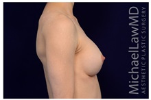 Breast Augmentation After Photo by Michael Law, MD; Raleigh, NC - Case 33163