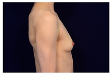 Breast Augmentation Before Photo by Michael Law, MD; Raleigh, NC - Case 33163