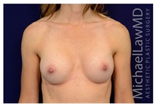 Breast Augmentation After Photo by Michael Law, MD; Raleigh, NC - Case 33164