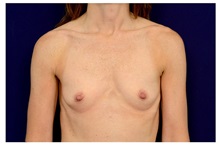 Breast Augmentation Before Photo by Michael Law, MD; Raleigh, NC - Case 33164