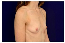 Breast Augmentation Before Photo by Michael Law, MD; Raleigh, NC - Case 33164