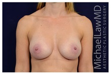 Breast Augmentation After Photo by Michael Law, MD; Raleigh, NC - Case 33167