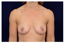 Breast Augmentation Before Photo by Michael Law, MD; Raleigh, NC - Case 33167