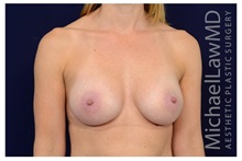 Breast Augmentation After Photo by Michael Law, MD; Raleigh, NC - Case 33167