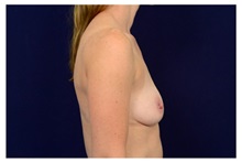 Breast Augmentation Before Photo by Michael Law, MD; Raleigh, NC - Case 33167
