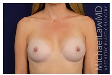 Breast Augmentation After Photo by Michael Law, MD; Raleigh, NC - Case 33168
