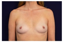 Breast Augmentation Before Photo by Michael Law, MD; Raleigh, NC - Case 33168